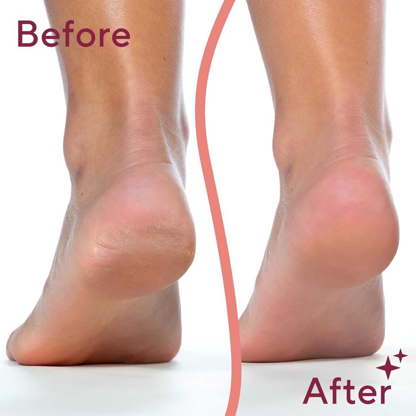 Callus and Dead Skin Remover Rechargeable